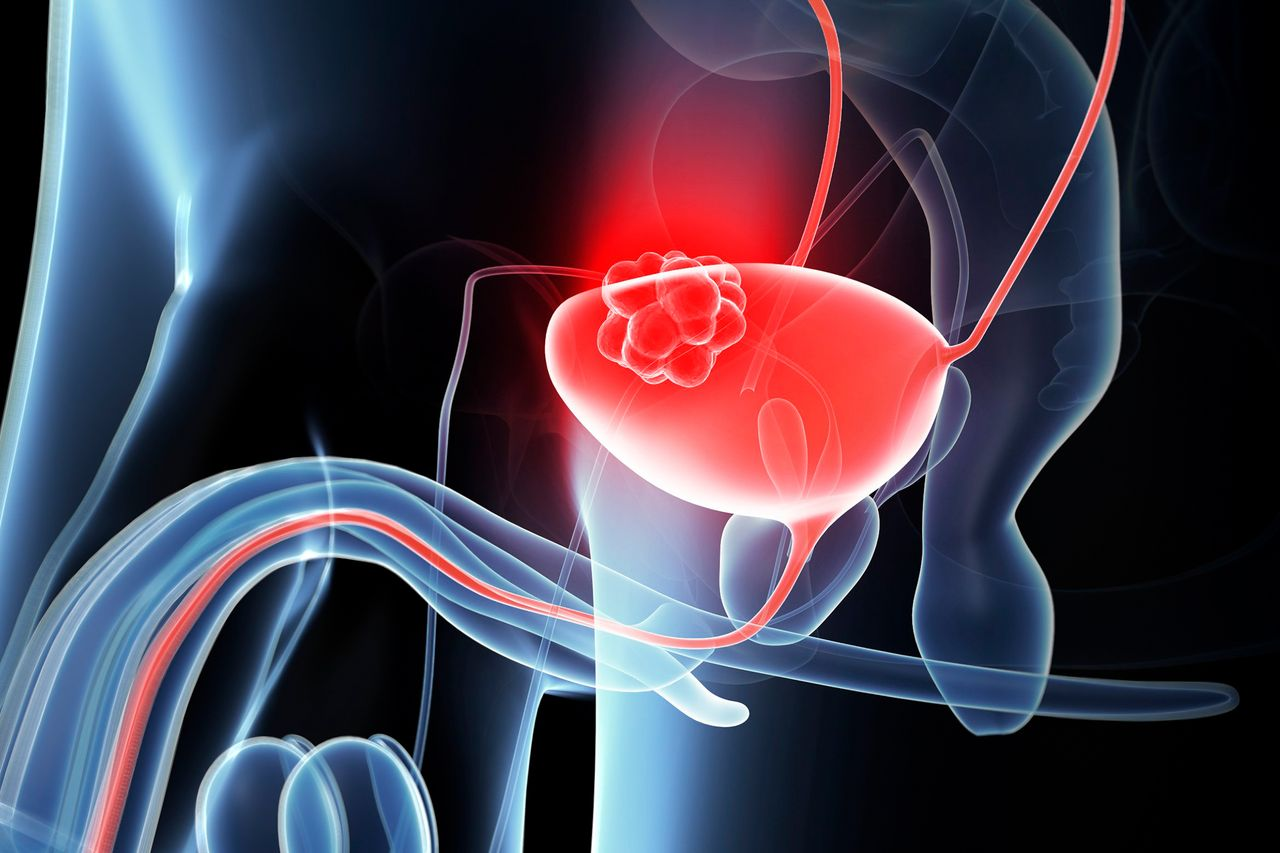 Novel ADC Combo Shows Efficacy in Phase 2 Bladder Cancer Data