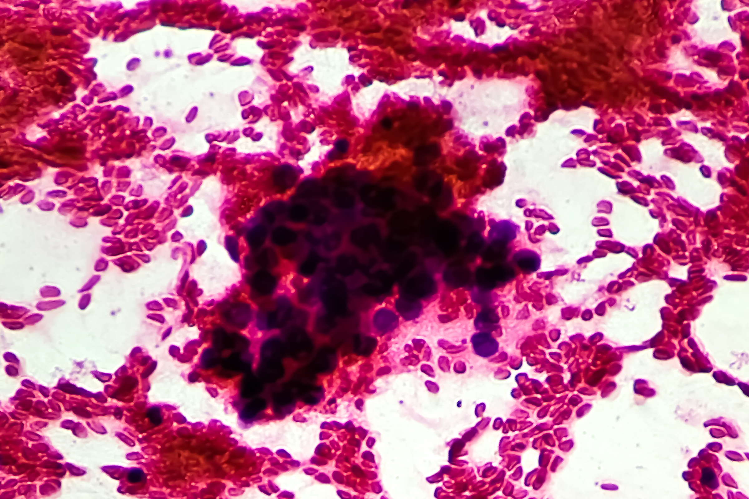 Immunotherapy Combination Significantly Improves Survival for Advanced ...