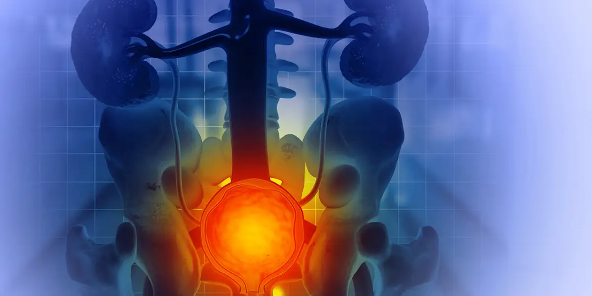 Photo: Oncologynewscentral Bladder Cancer Care Enters New Era With Advanced Diagnosis and Treatments
