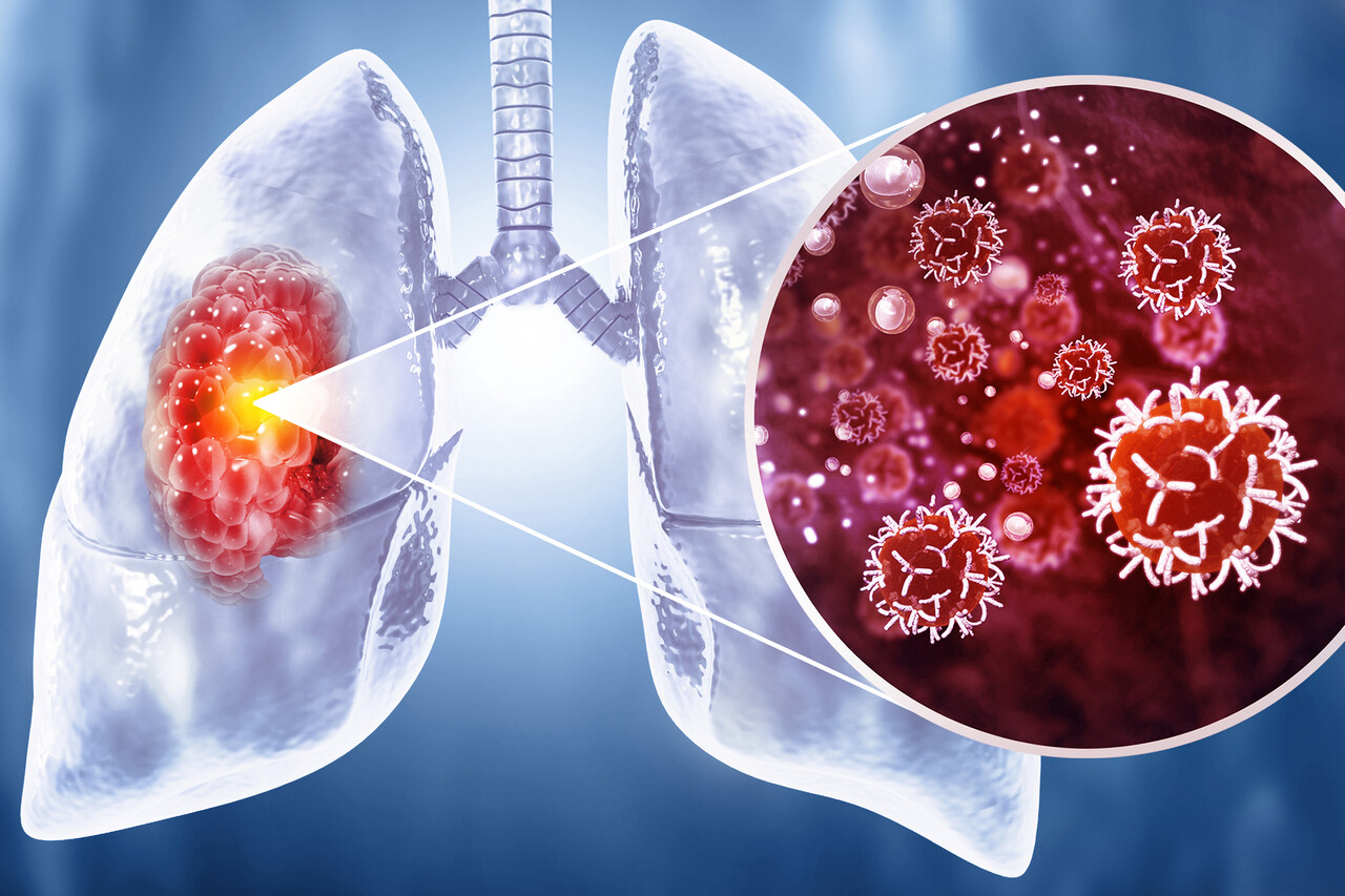 Alectinib Improves DFS Over Chemotherapy in Early-Stage, ALK+ NSCLC