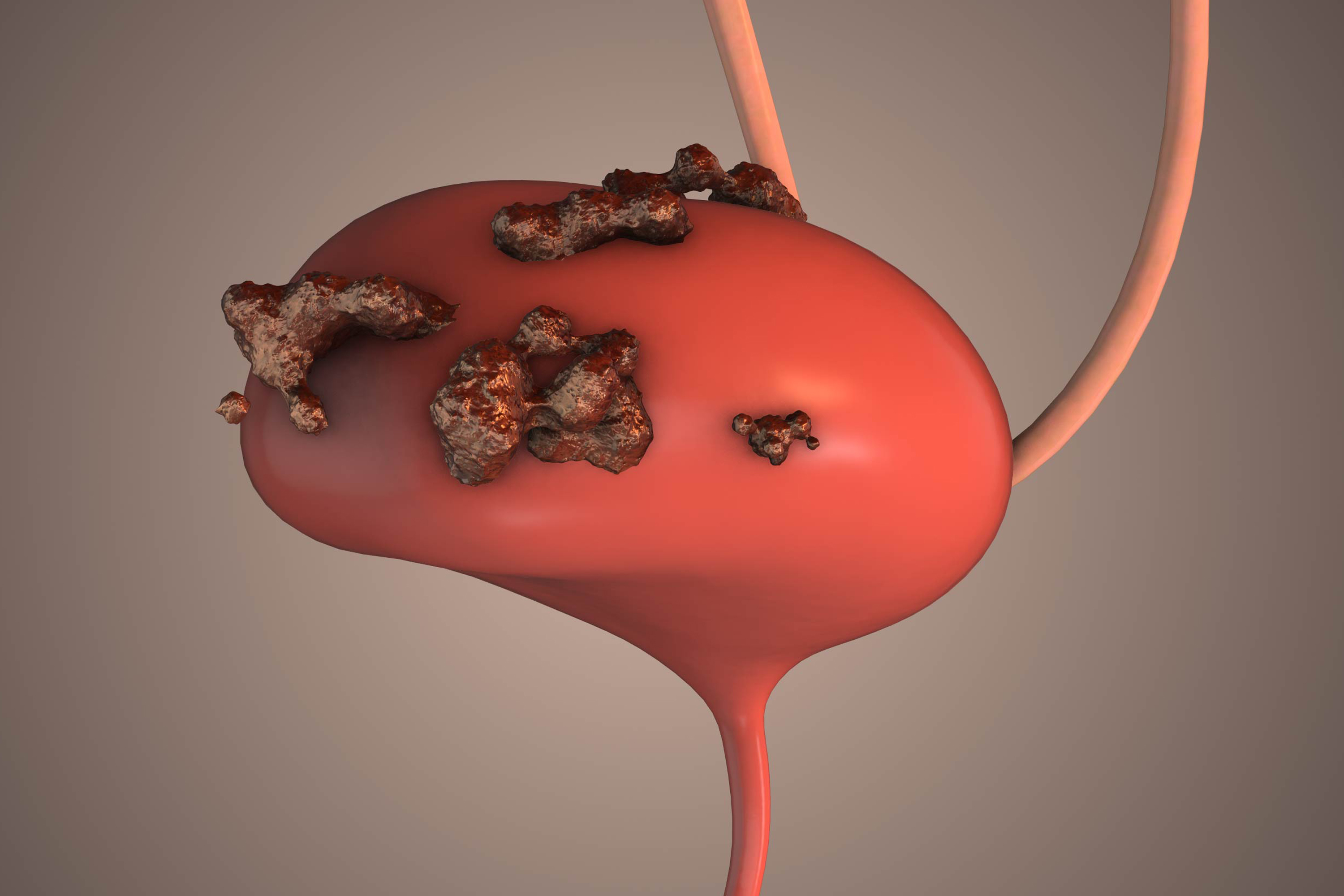 Use of Local Therapy After EV-Pembro in Advanced Bladder Cancer “Striking”