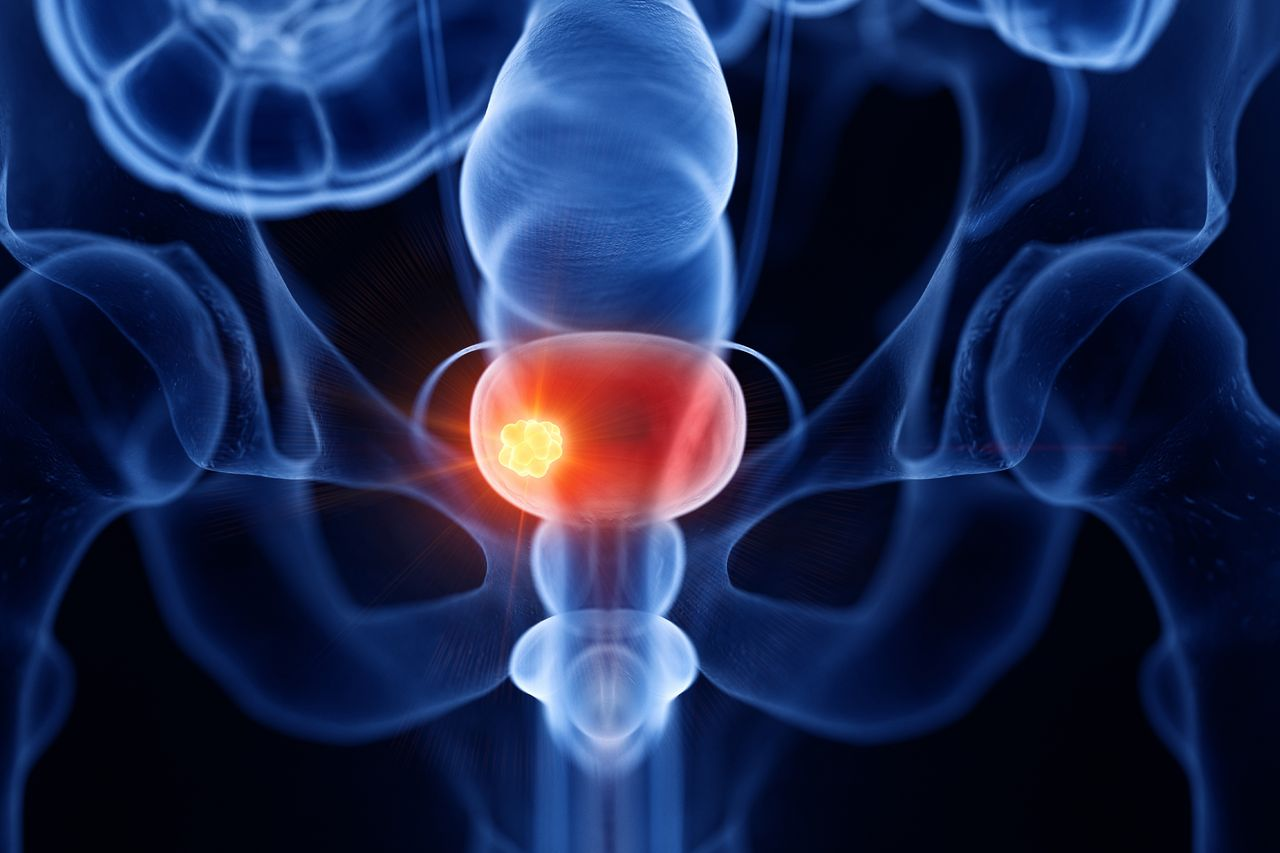 Zele in Combination With Pembrolizumab Shows Promise in Bladder Cancer