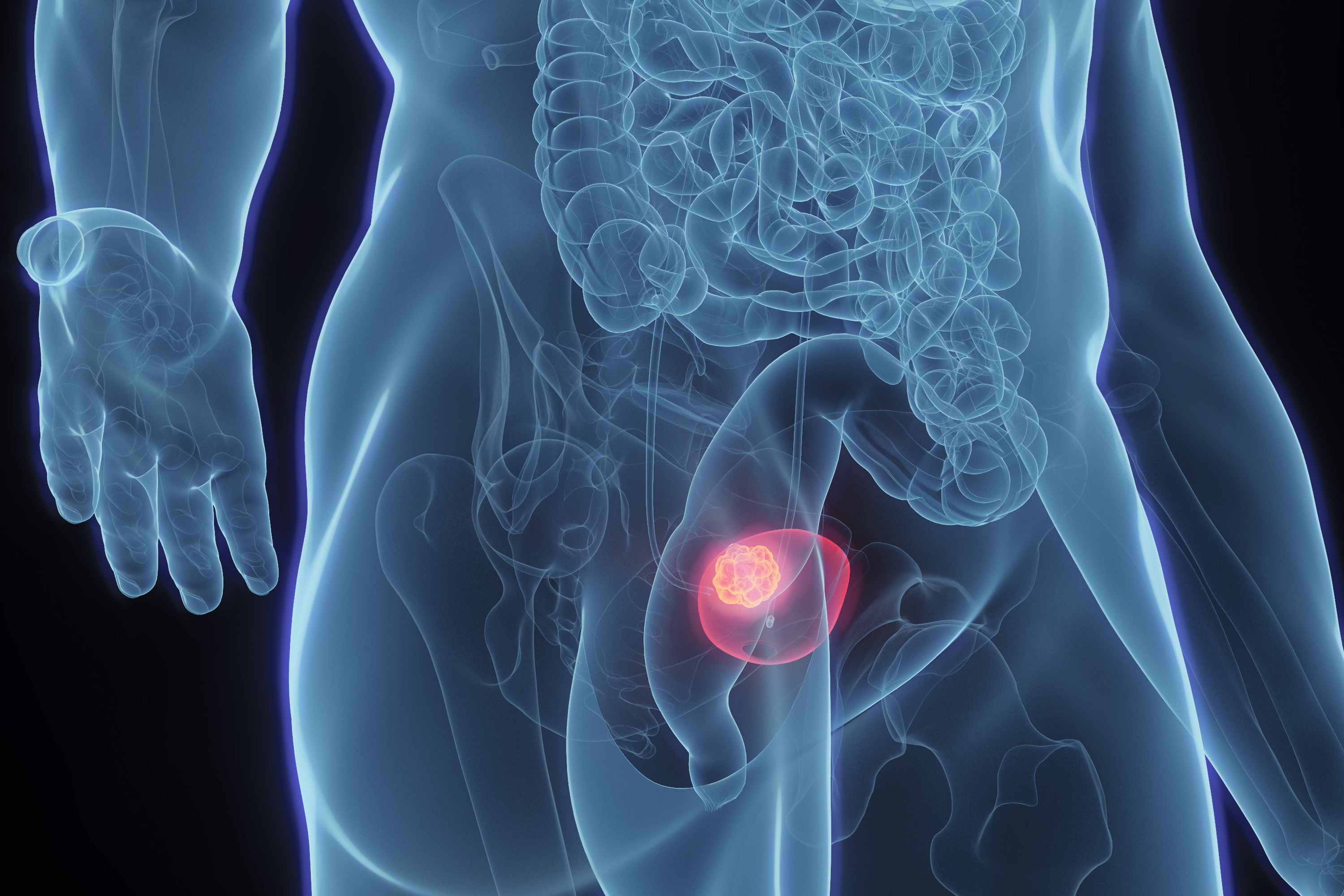 FDA Approves Enfortumab Vedotin Combo for Advanced or