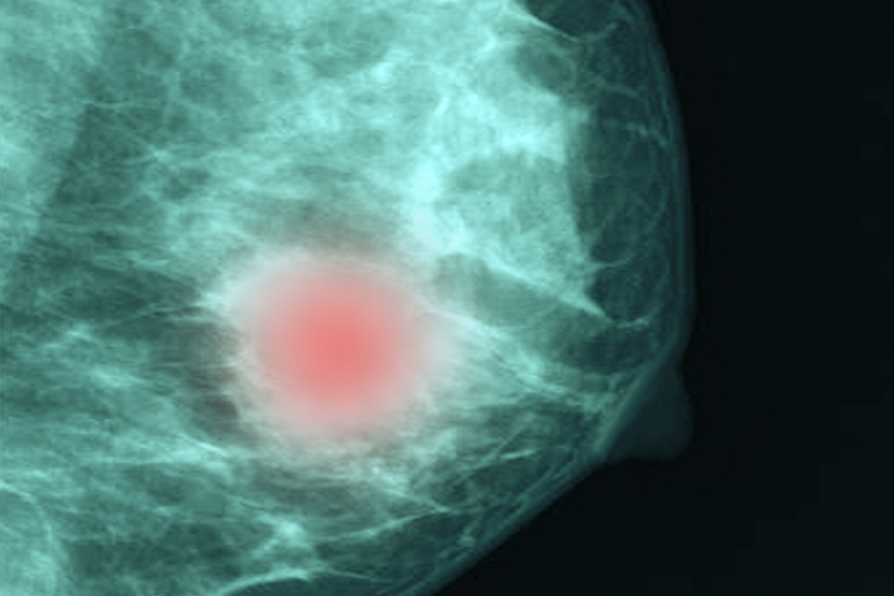健康・医学 Breast Cancer Breast Cancer Calculators