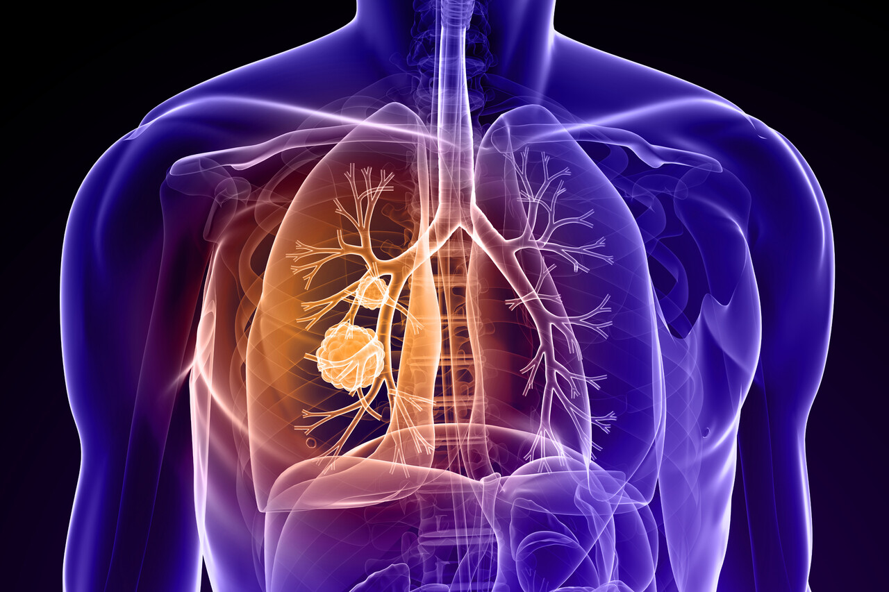 Bispecific May Be New Standard of Care for Certain NSCLC, HARMONi-6 Data at ESMO 2025 Suggest