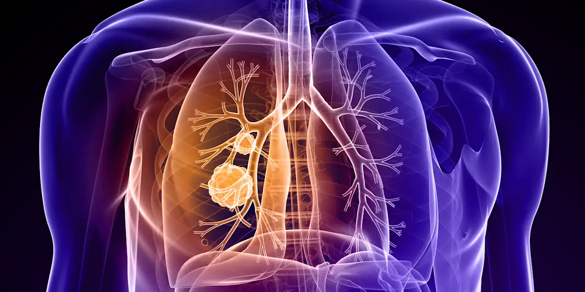 Bispecific May Be New Standard of Care for Certain NSCLC, HARMONi-6 Data at ESMO 2025 Suggest