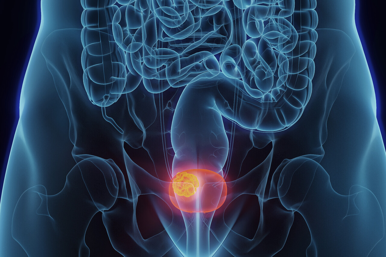 Fda Approves Erdafitinib For Advanced Bladder Cancer