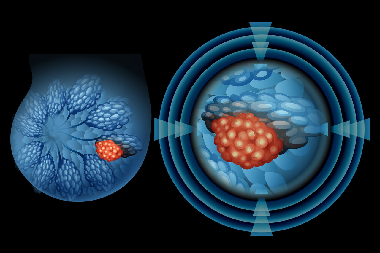 SOUND Advice? Real-World Data Back Skipping SLNB in Some Breast Cancer ...