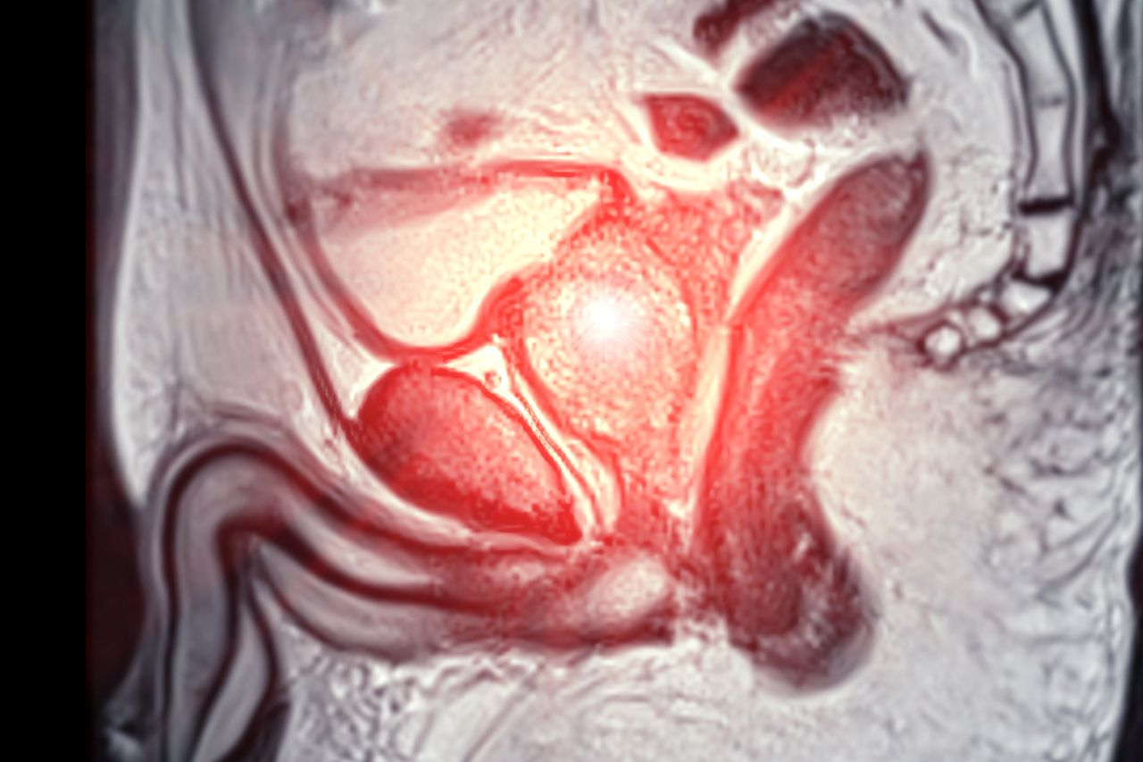 PROTEUS Trial: Perioperative Approach Improves Metastasis-Free Survival in Prostate Cancer