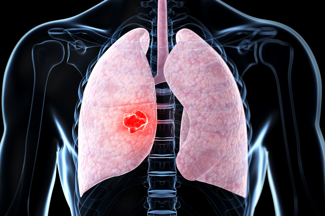 腎臓内科Controversy FDA Approves Dato-DXd (Datroway) for EGFR-Positive Non-Small