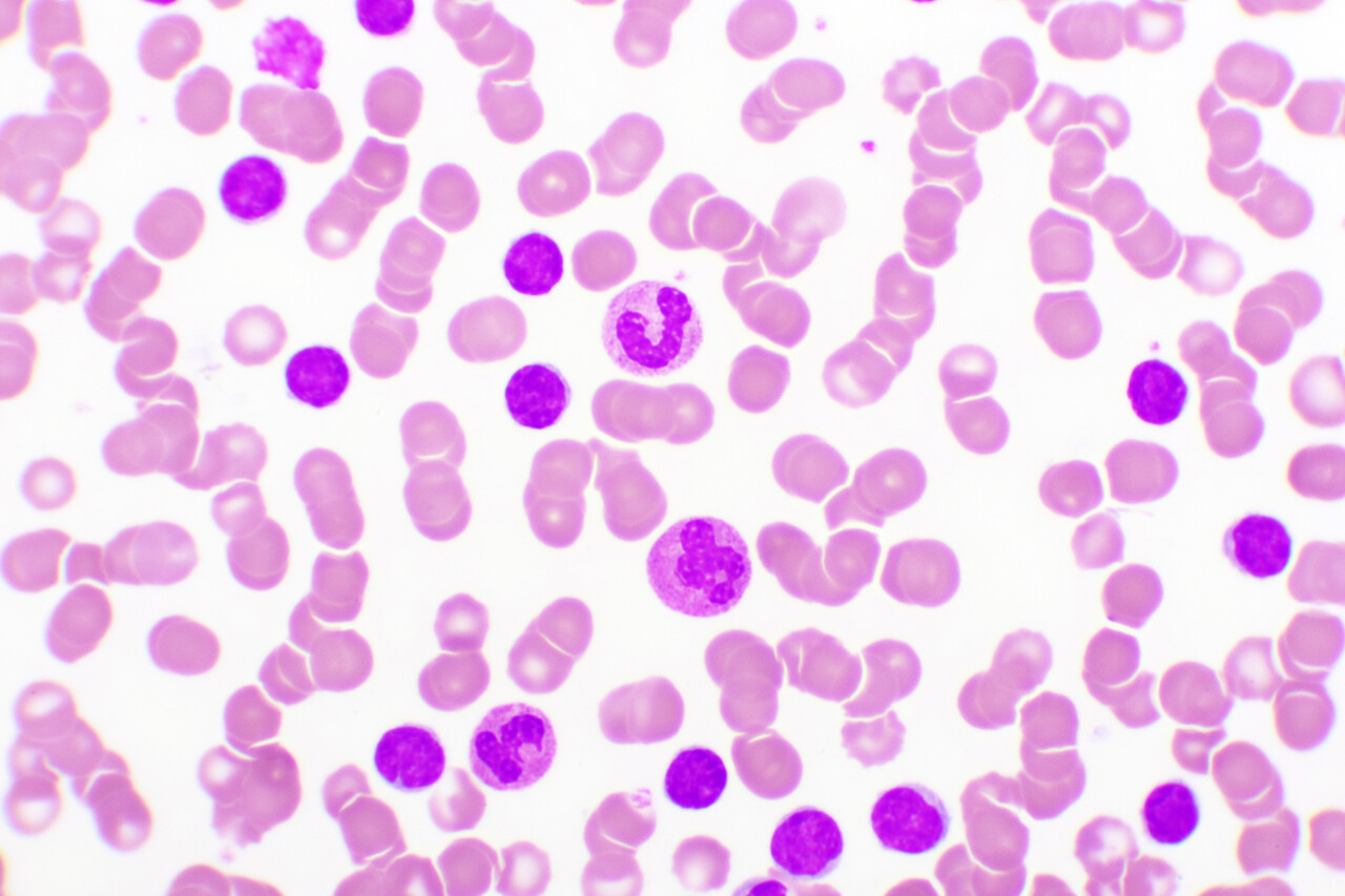 New “Gold Standard” for Previously Untreated CLL, as Ibrutinib ...