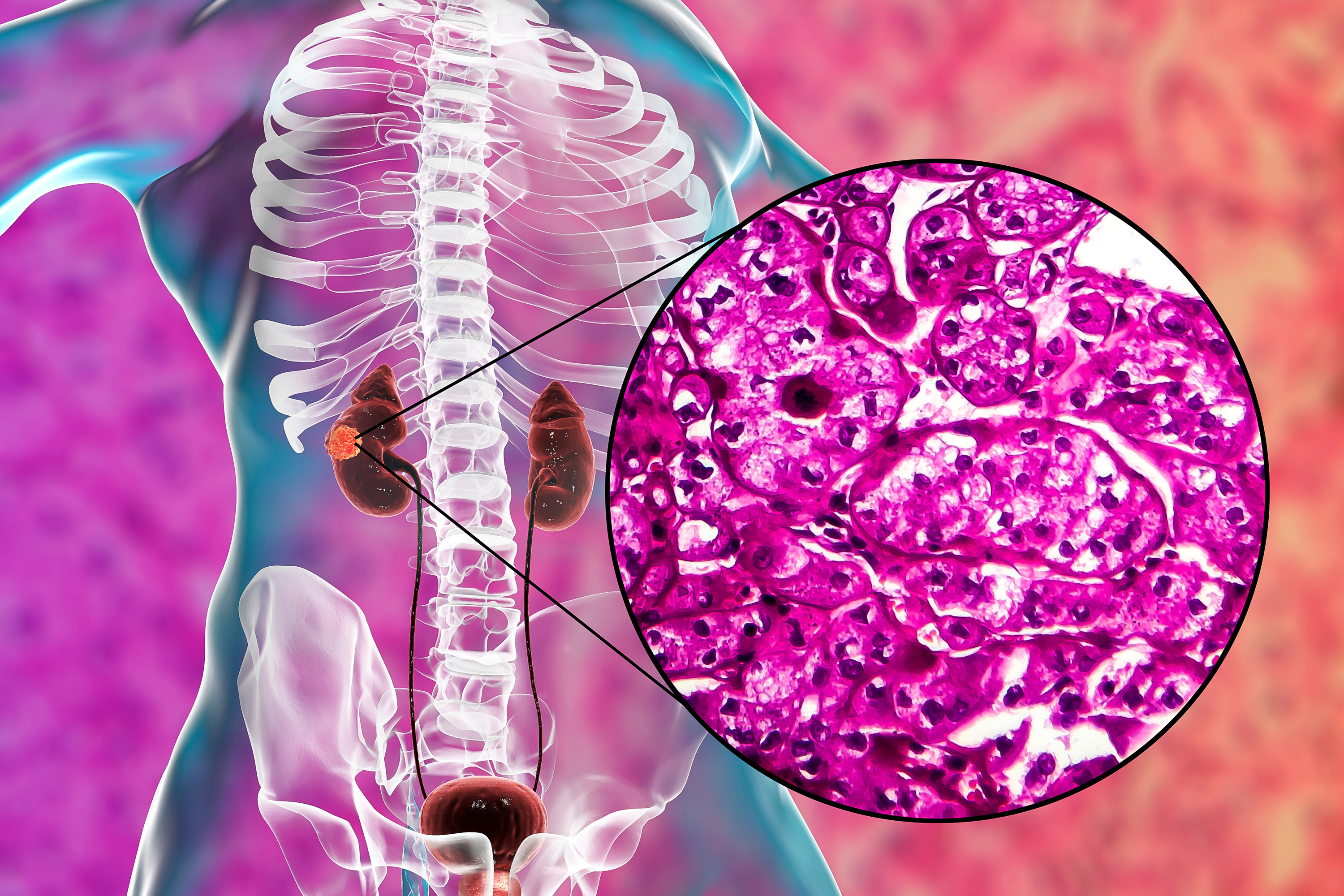 Atezolizumab Ups Toxicity, Not Outcomes in Metastatic Renal Cell