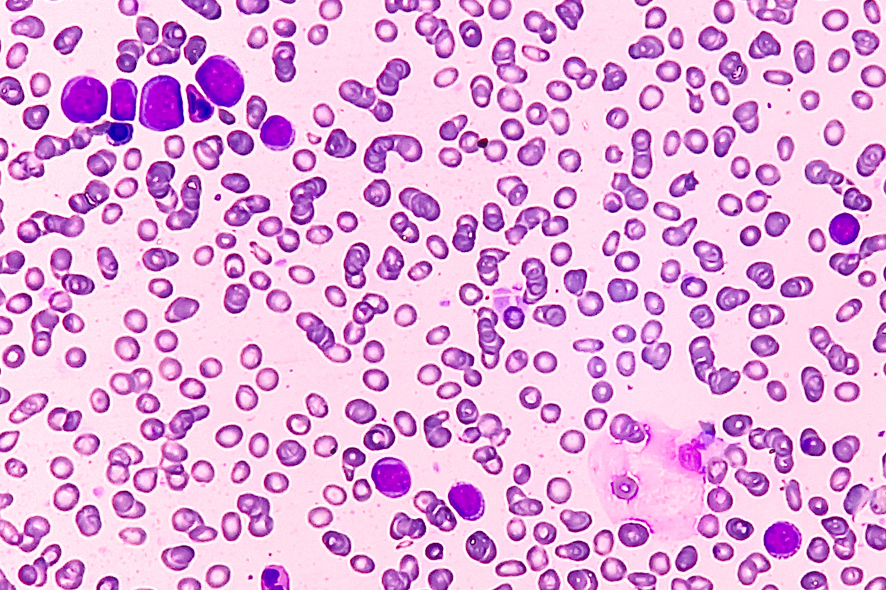 FDA Approves Revumenib for Acute Myeloid Leukemia with Susceptible NPM1 ...