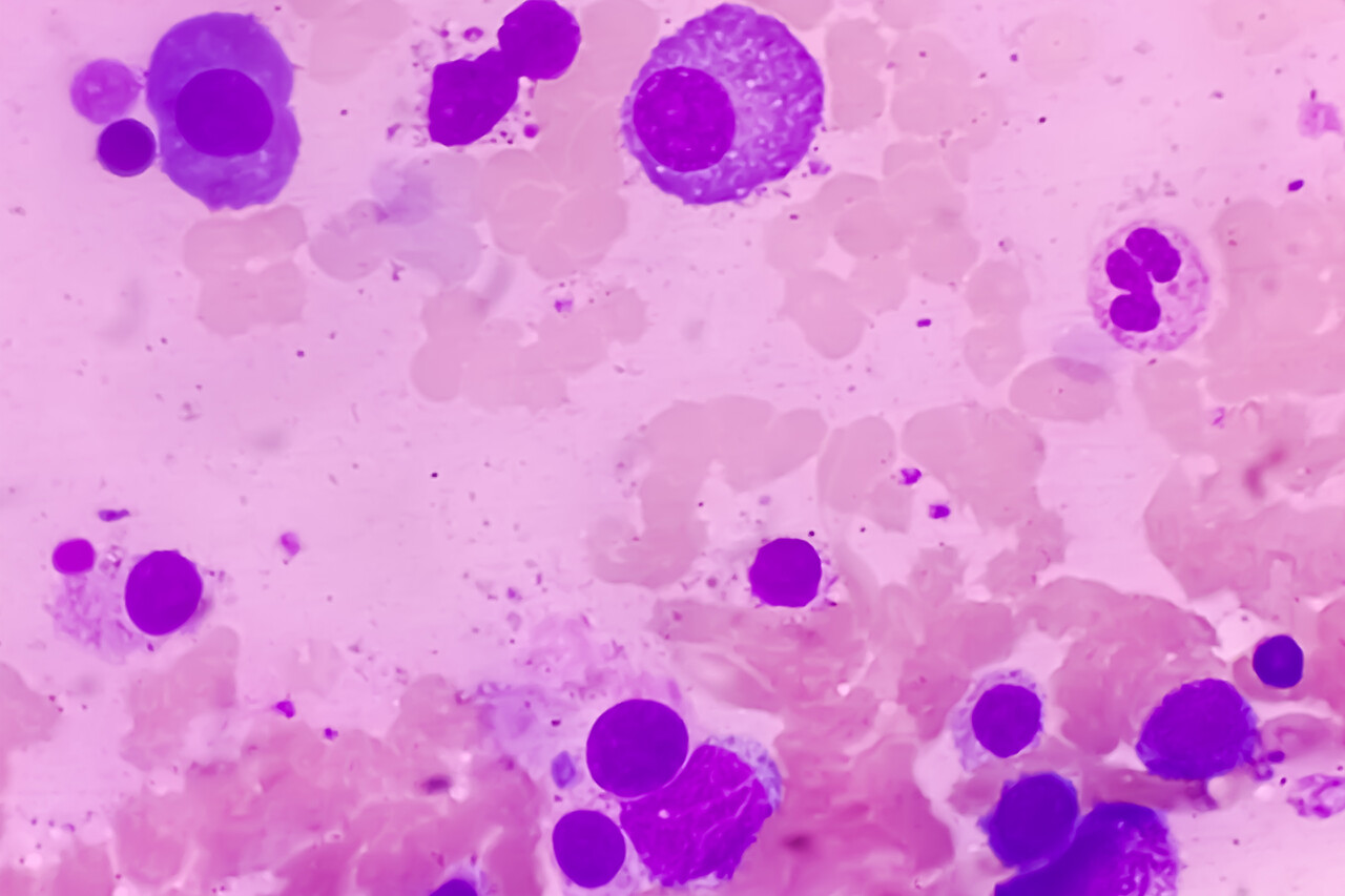 FDA Approves Daratumumab Quadruplet for Multiple Myeloma