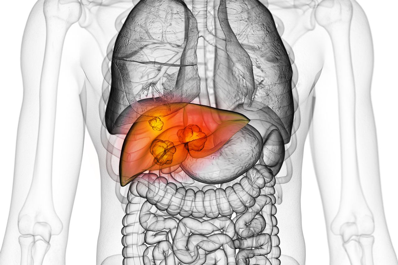 EMERALD-3 Trial: STRIDE Regimen Improves PFS in Liver Cancer