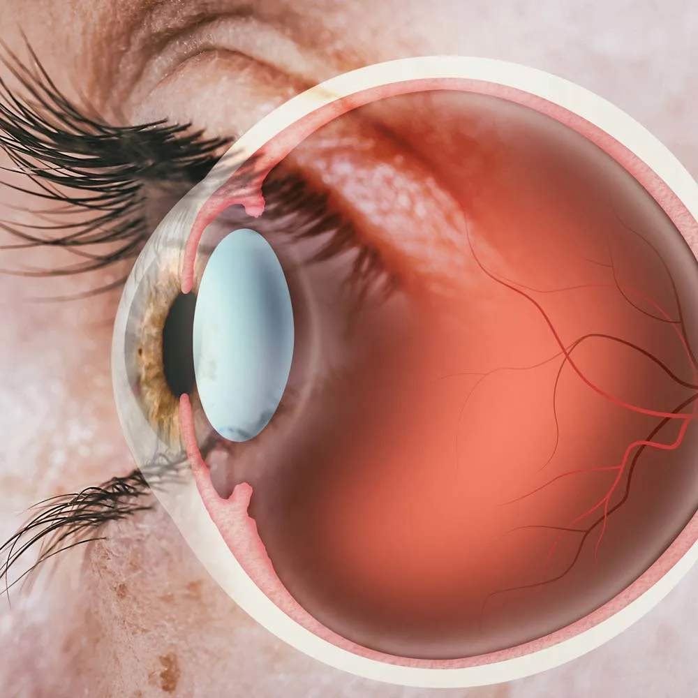 Retinal Detachment Surgery