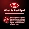 What is Red Eye? Red Eyes are caused by swollen or dilated blood vessels on the white, outer surface of your eye.