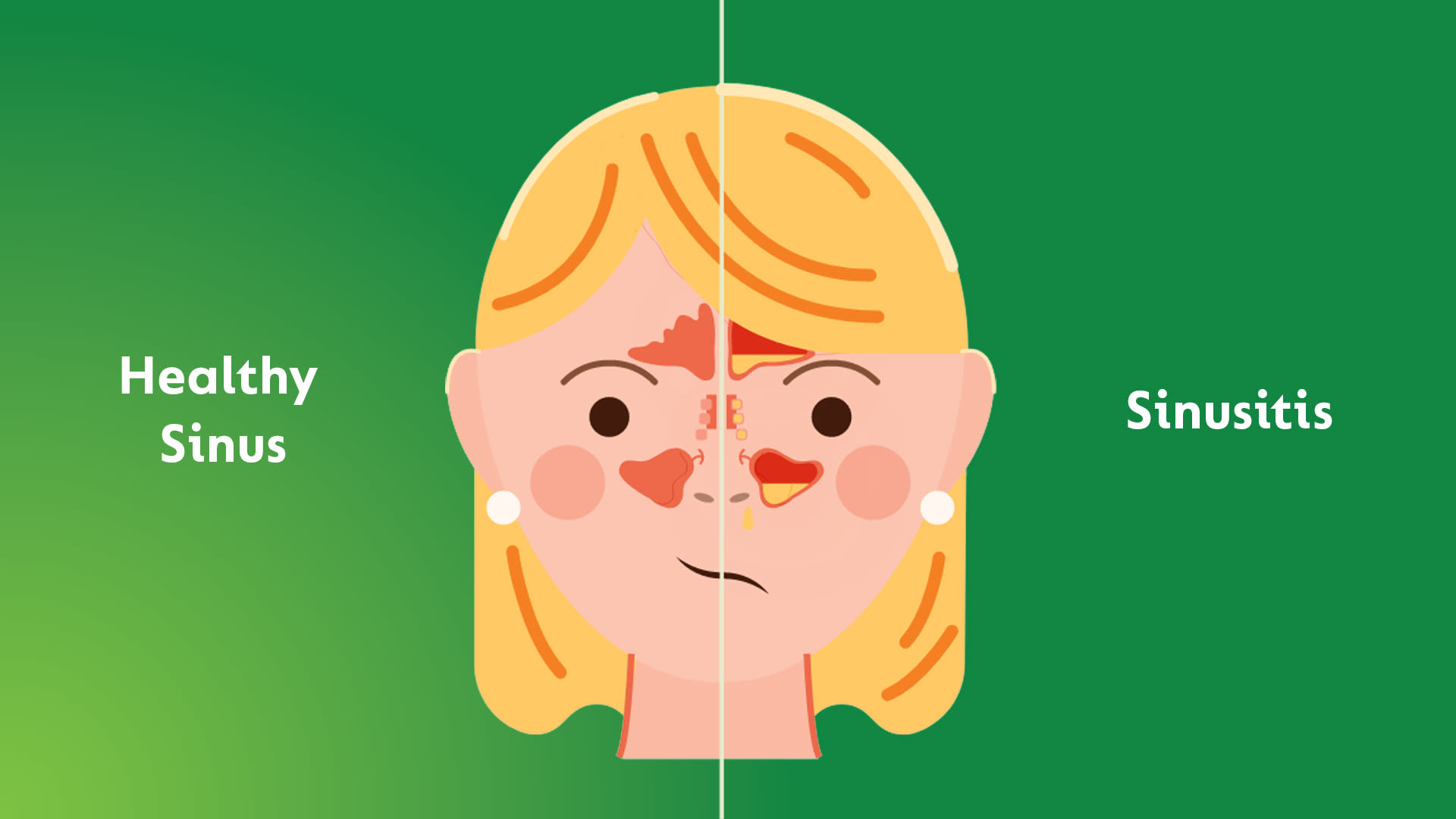 Diagram of woman showing healthy sinuses vs. sinusitis