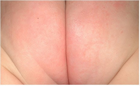 Mild to Moderate Diaper Rash Picture