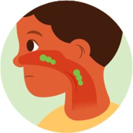 Postnasal drip