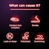 Red eye can be caused by contact lens irritation, smoke, lack of sleep, pollutants, and swimming