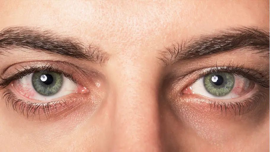 A closeup of a person with green eyes experiencing redness