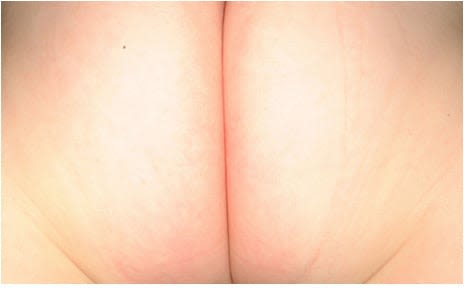 Mild Diaper Rash Picture