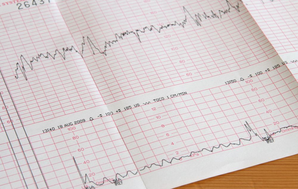 CTG-Werte von Herzschlag und Wehentätigkeit als Kurve
