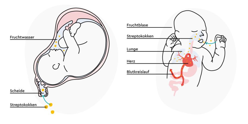 Illustration eines Babys im Mutterleib zeigt den Verlauf einer Streptokokken-Infektion in zwei Schritten: Erst gelangen die Streptokokken in das Fruchtwasser und dann durch die Lunge in den Blutkreislauf des Babys.
