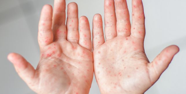 Kleinkind zeigt seine Handflächen mit roten Flecken durch die Hand-Mund-Fuß-Krankheit