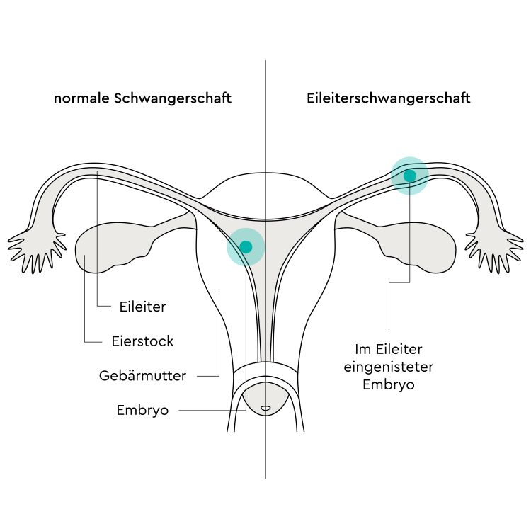 Infografik der Einnistung der Eizelle bei einer normalen im Vergleich zu einer Eileiterschwangerschaft
