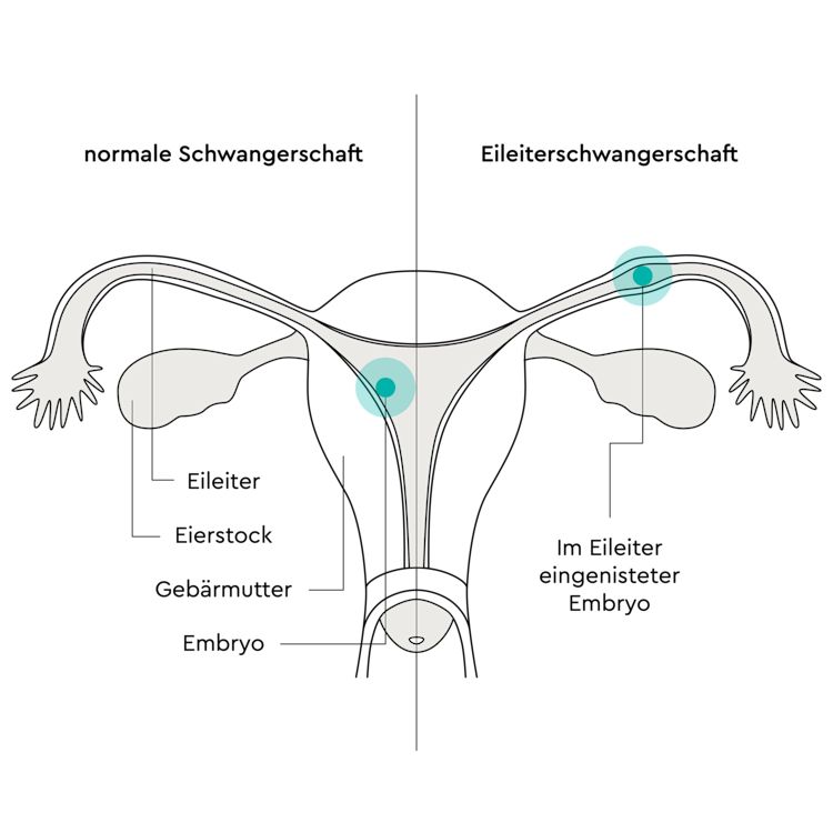Eileiterschwangerschaft LILLYDOO Magazin Eileiterschwangerschaft LILLYDOO Magazin