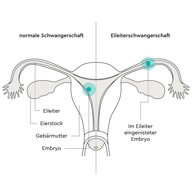 Infografik der Einnistung der Eizelle bei einer normalen im Vergleich zu einer Eileiterschwangerschaft