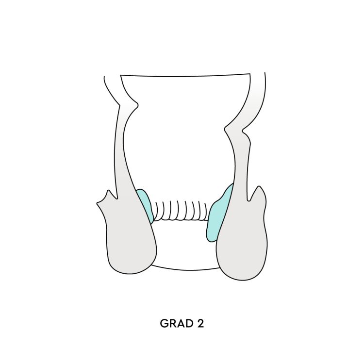 Hämorrhoiden Grad 2