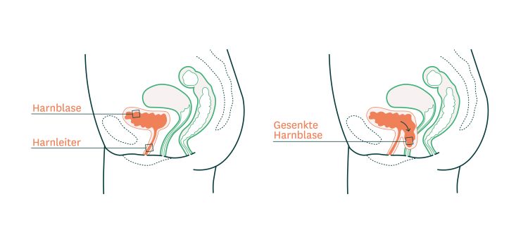 Illustration zeigt, wo die Harnblase im gesunden Zustand im Becken sitzt und wie sie sich bei einer Blasensenkung verändert.