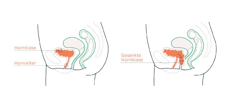 Illustration zeigt, wo die Harnblase im gesunden Zustand im Becken sitzt und wie sie sich bei einer Blasensenkung verändert. Illustration zeigt, wo die Harnblase im gesunden Zustand im Becken sitzt und wie sie sich bei einer Blasensenkung verändert.