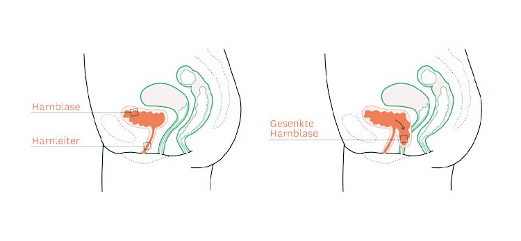Illustration zeigt, wo die Harnblase im gesunden Zustand im Becken sitzt und wie sie sich bei einer Blasensenkung verändert.