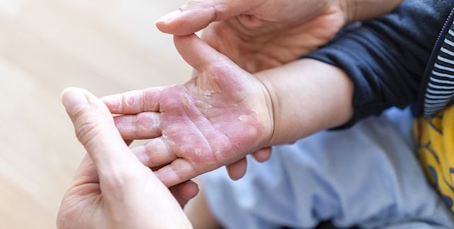 Erwachsene Person hält verbrannte Kinderhand in den eigenen Händen, um sie zu verarzten. 