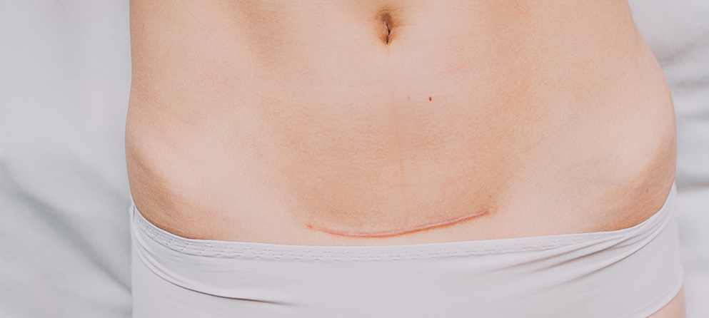 Soins De La Cicatrice Post Cesarienne Lillydoo Magazine