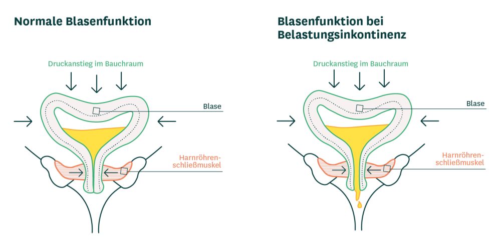 Infografik stellt die normale Blasenfunktion und die Blasenfunktion bei Belastungsinkontinenz gegenüber, wodurch sichtbar wird, dass der Harnröhrenschließmuskel den Harn bei Belastungsinkontinenz nicht halten kann. Infografik stellt die normale Blasenfunktion und die Blasenfunktion bei Belastungsinkontinenz gegenüber, wodurch sichtbar wird, dass der Harnröhrenschließmuskel den Harn bei Belastungsinkontinenz nicht halten kann.