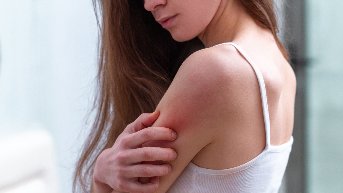 A person scratching their arm. Their skin is red and irritated looking.
