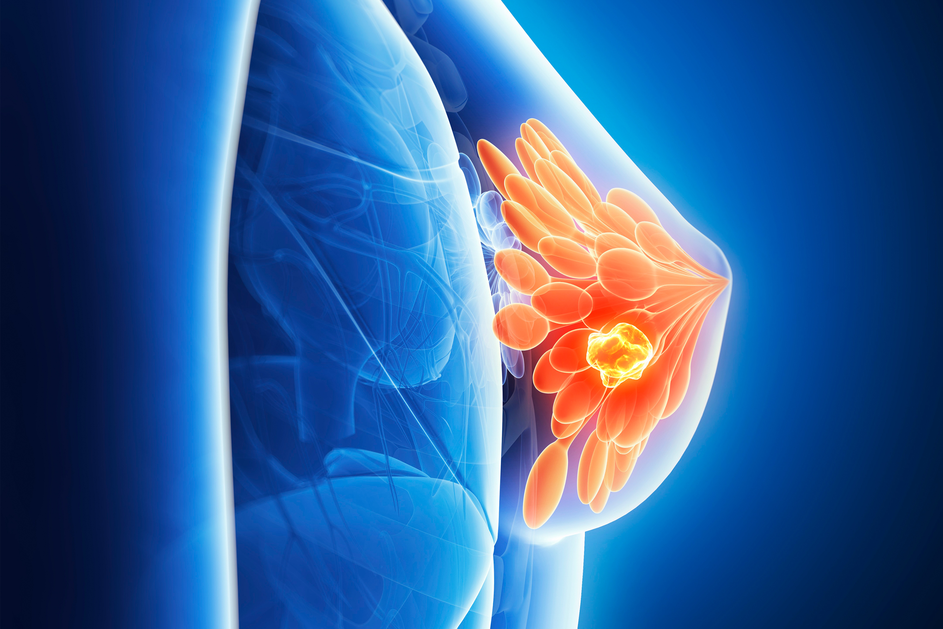 glp 1 and breast cancer GLP-1s: Weight Loss Survival in Recovery GLP-1 Drugs May Improve Survival