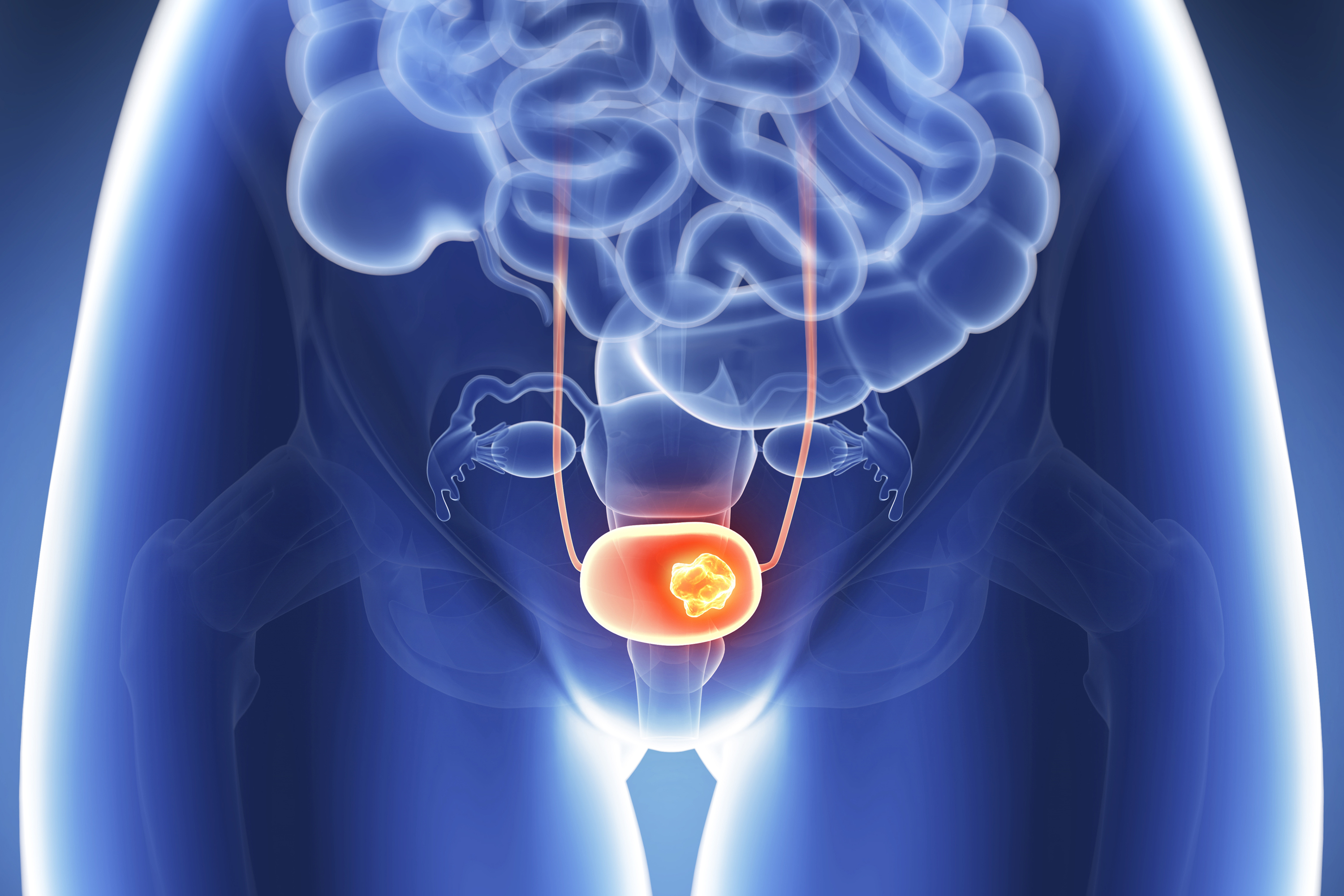 Treatment Options for Advanced Bladder Cancer