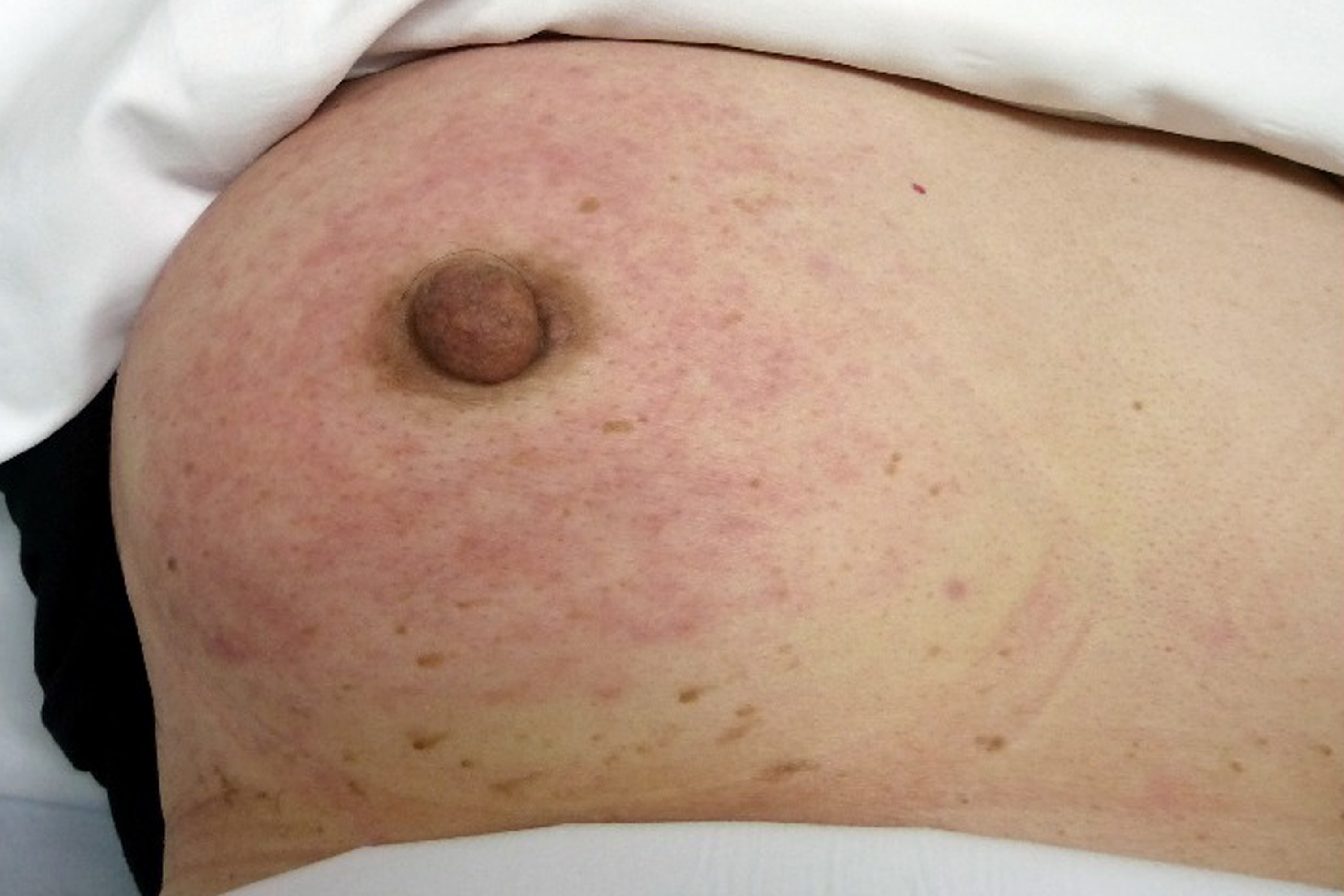 Can Breast Cancer Cause a Rash?