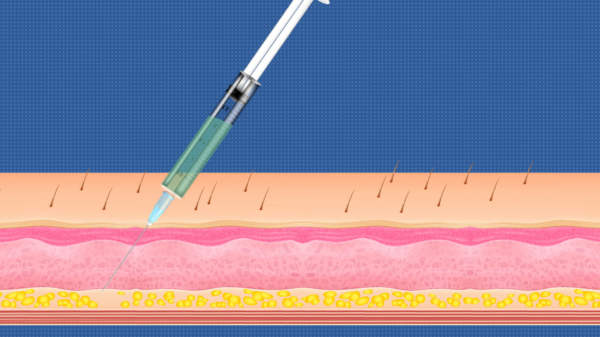 Explore Sub-Q Treatment in Our Animated Guide
