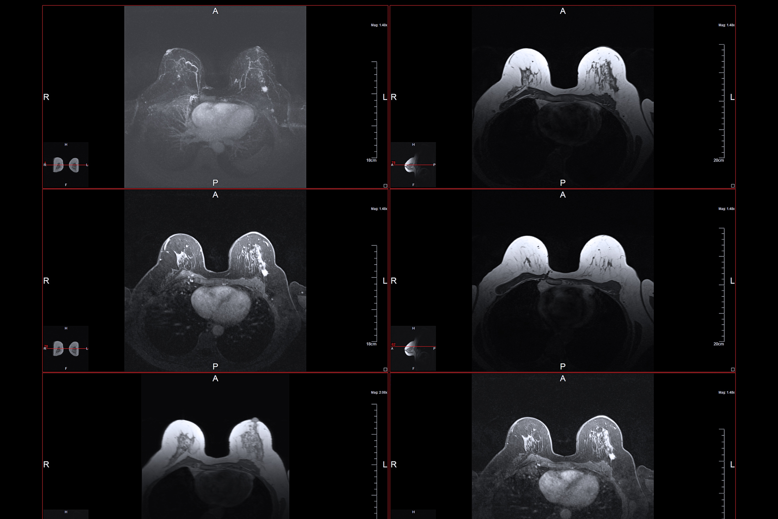 Breast MRI: What Is It, Procedure and More