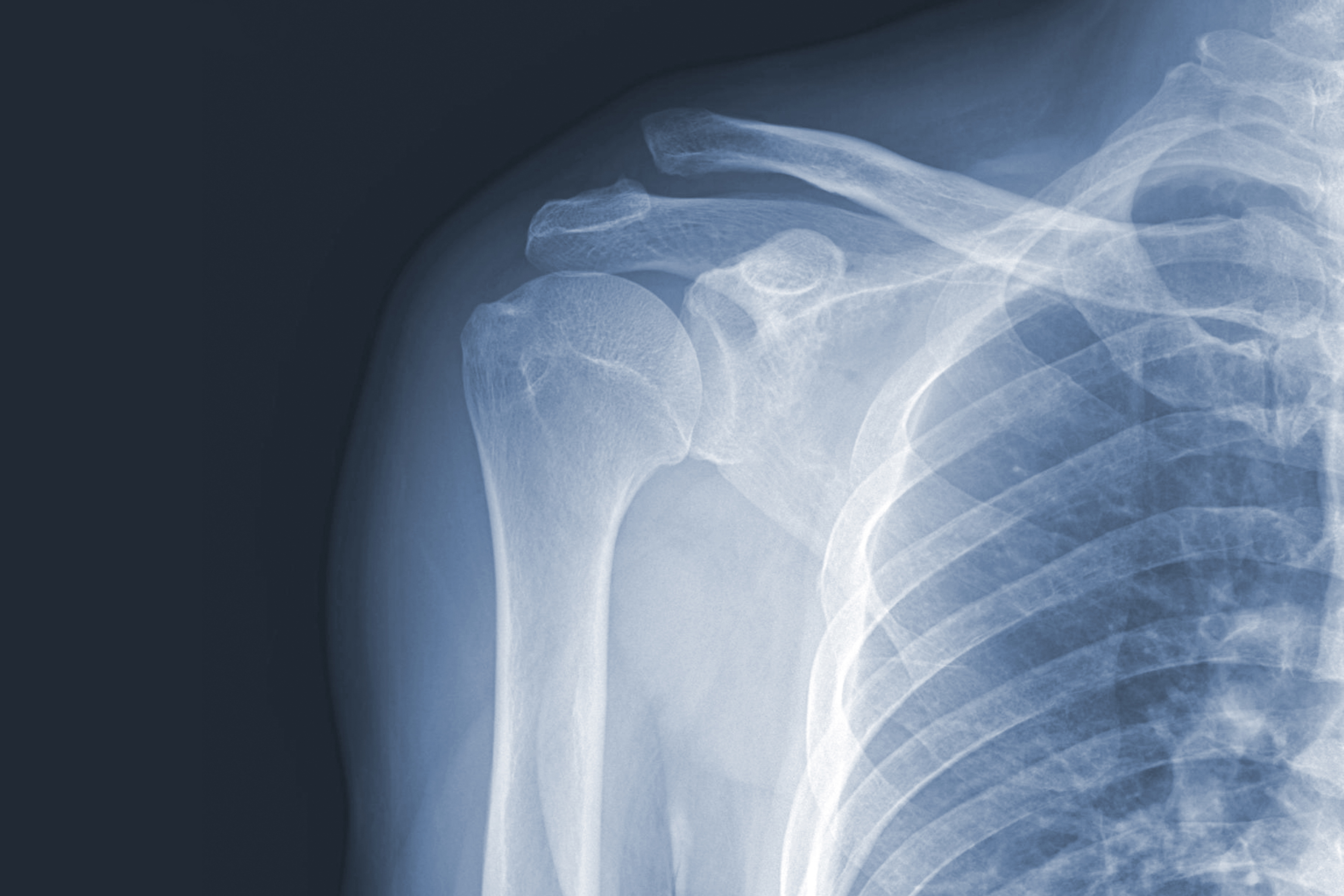 X Ray Images Of Shoulder Joint GettyImages 1430273343 