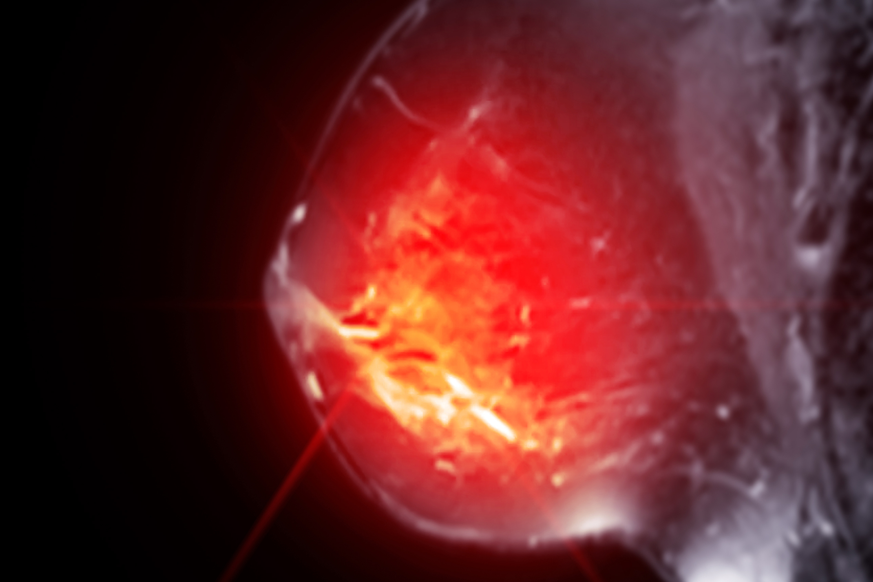 Breast Cancer Tumor Size Chart Staging & Prognosis