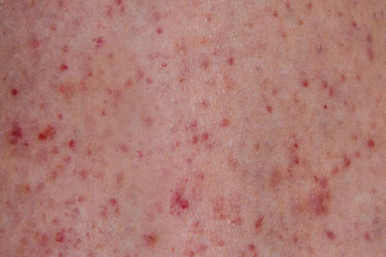 bright pink spots on skin