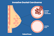 Bilder Von Invasive Ductal Breast Cancer Signs Treatments NINE Bilder Von Invasive Ductal Breast Cancer Signs Treatments NINE